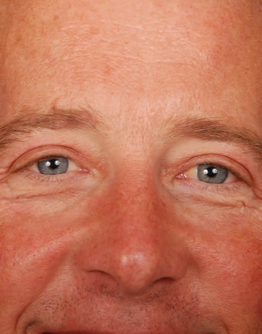 Blefaroplastia Eyelid surgery