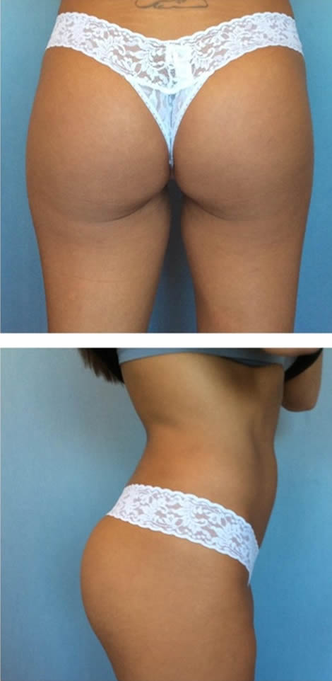 Buttock Implant Medical Tourism