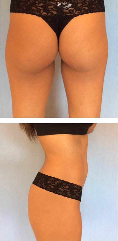 Buttock Implant Medical Tourism