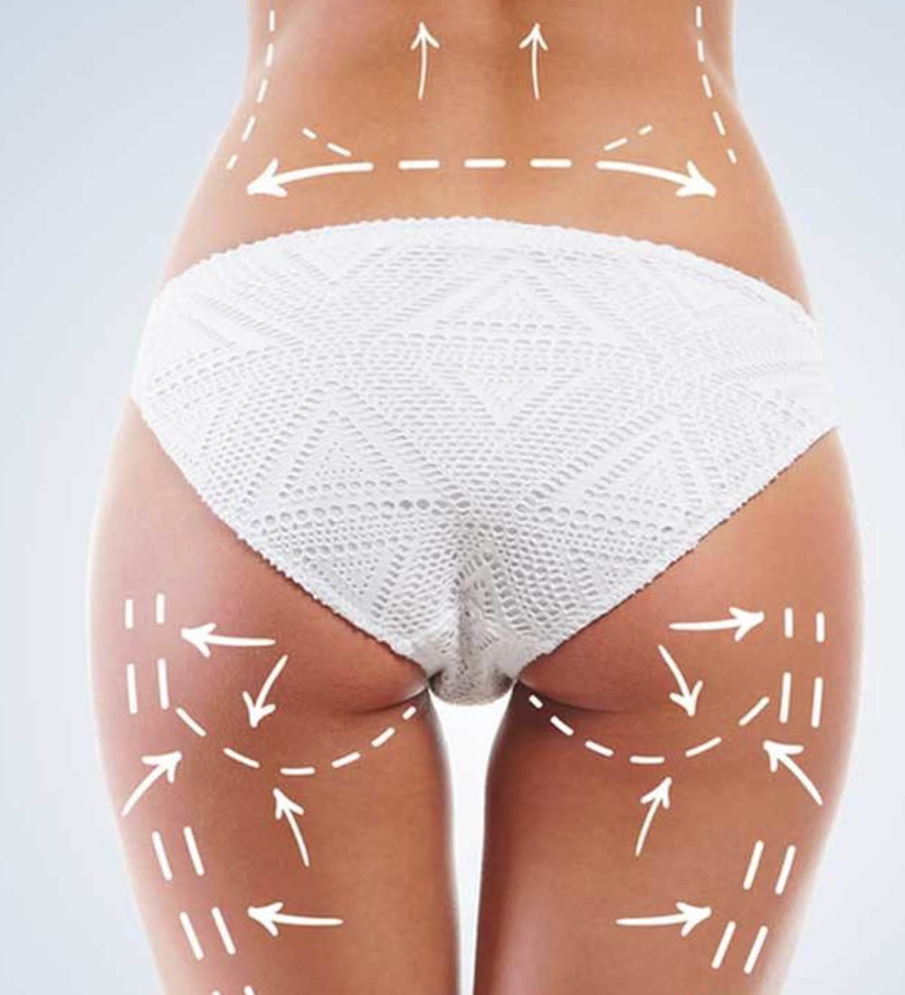 Buttock Implant Medical Tourism