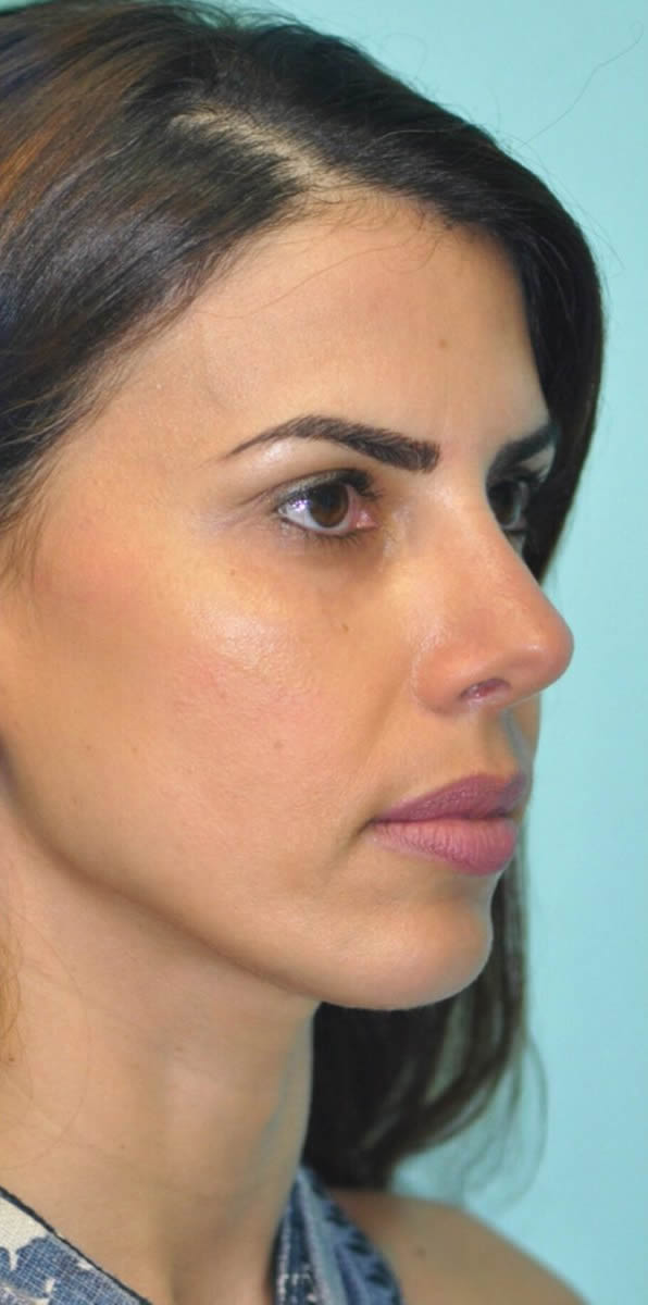 Chin implant Medical Tourism | Puerto Vallarta | Plastic Surgeon | Rhinoplasty