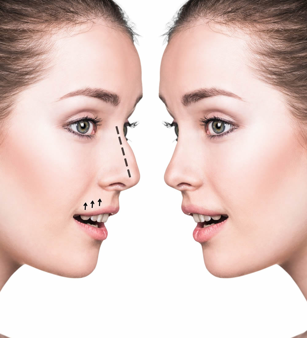 Rhinoplasty Medical Tourism