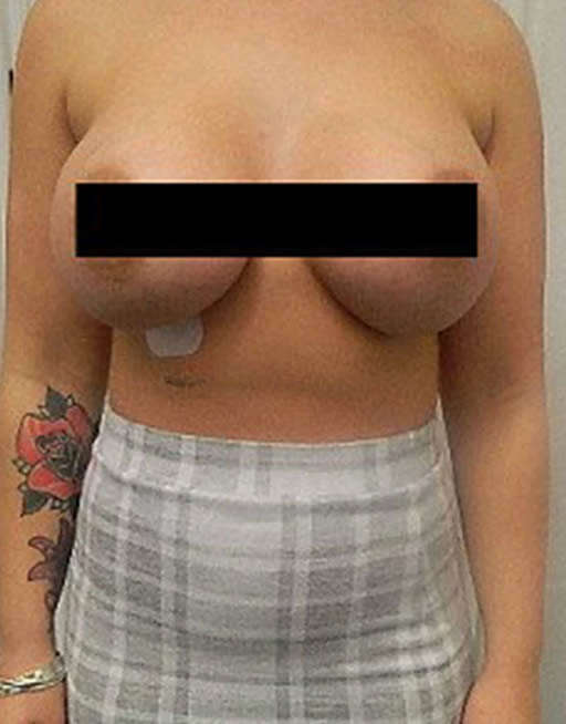 Puerto Vallarta Before and After Breat surgery | Boob Job | Cosmetic Surgery Mexico