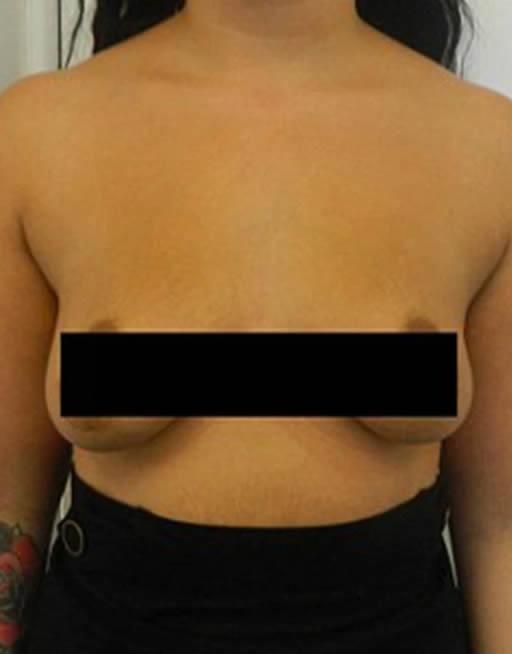 Puerto Vallarta Before and After Breat surgery | Boob Job | Cosmetic Surgery Mexico